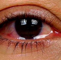 Lutein deficit - dry eyes