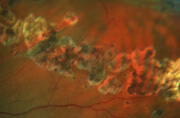 Retinal dystrophy before Optivision