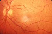 Retinal dystrophy after Optivision